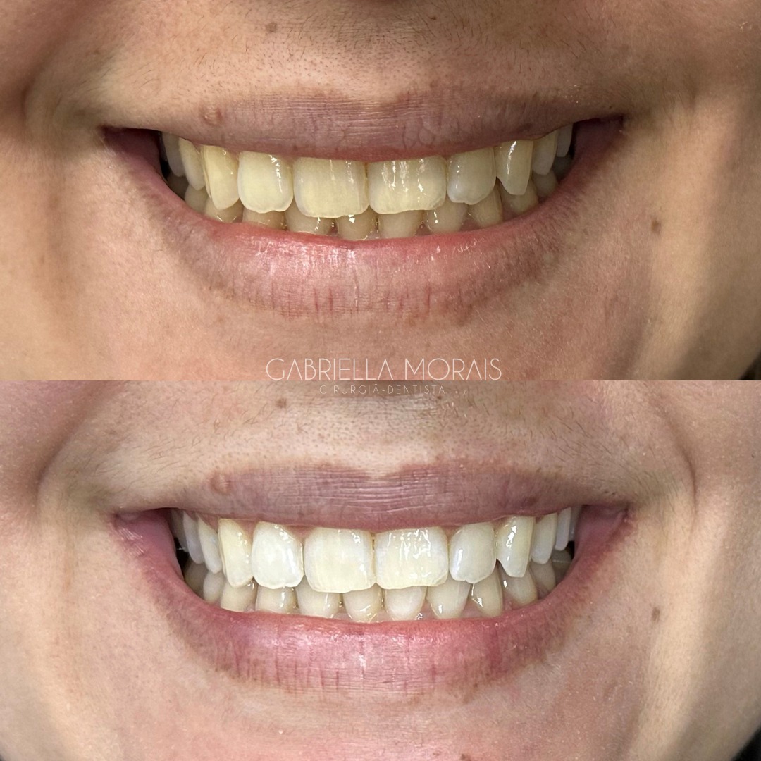 Caso 11 - Antes e Depois