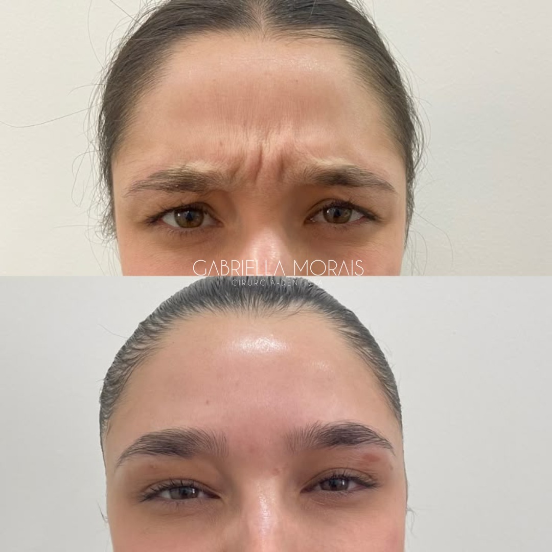 Caso 15 - Antes e Depois