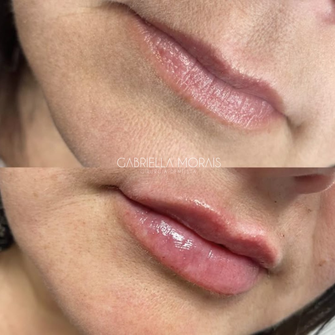 Caso 18 - Antes e Depois