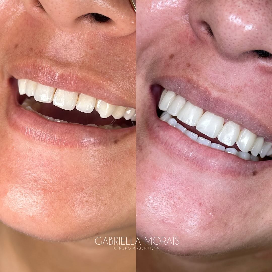 Caso 2 - Antes e Depois