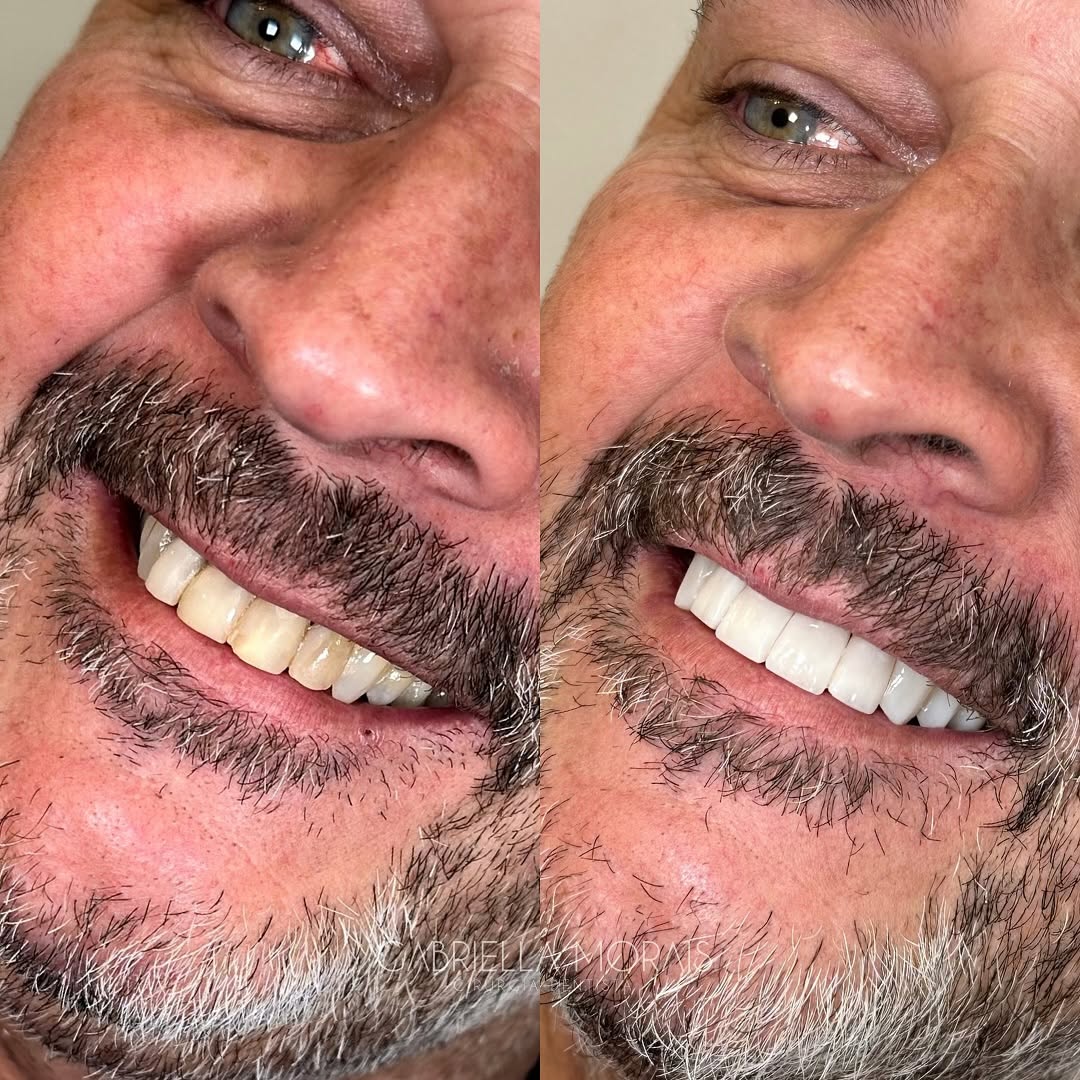 Caso 5 - Antes e Depois