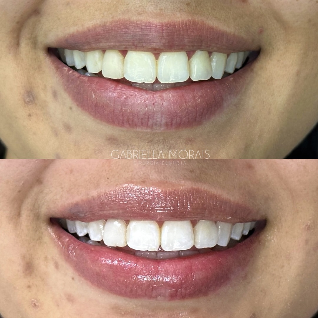 Caso 9 - Antes e Depois